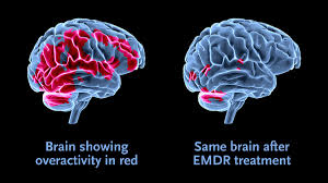 Imagem de uma ressonância magnética do cérebro após sessões de EMDR